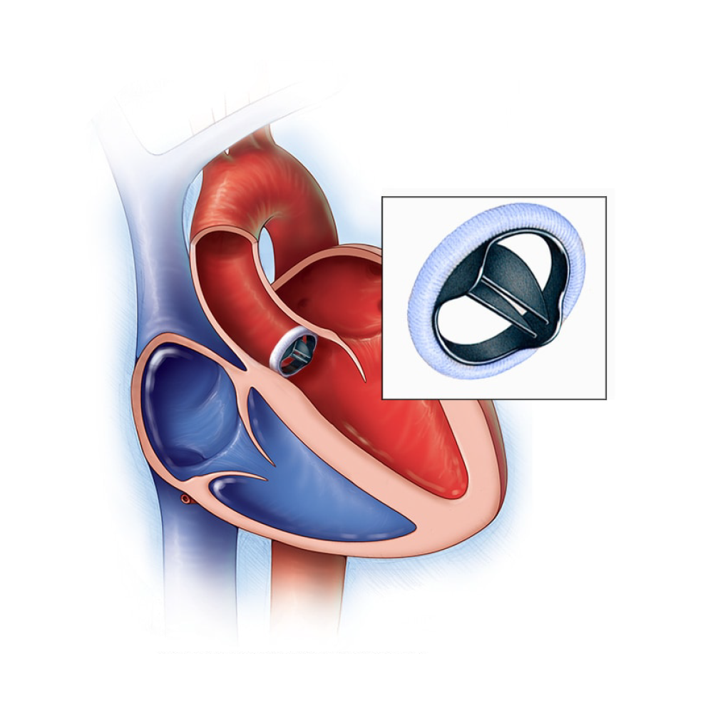 Heart Valve Surgeries